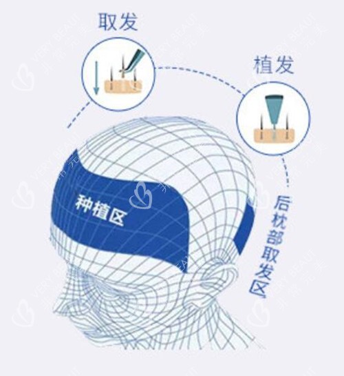 植发流程