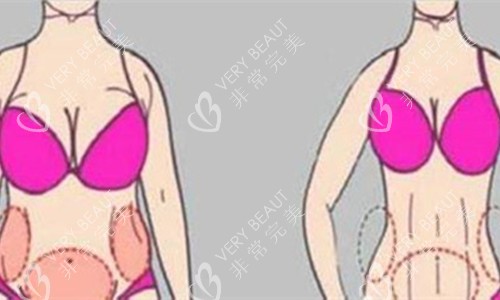 腰腹吸脂对比图 腰腹吸脂对比图