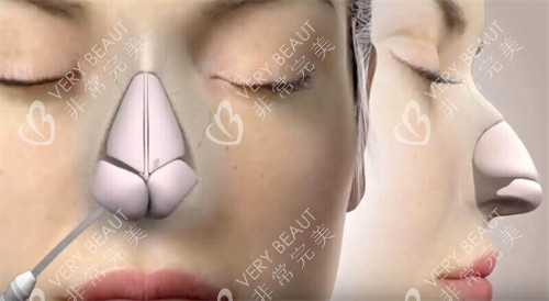 隆鼻手术动画图