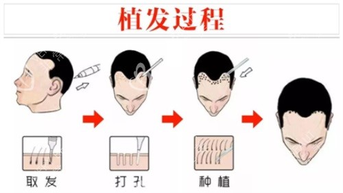 植发过程示意图展示