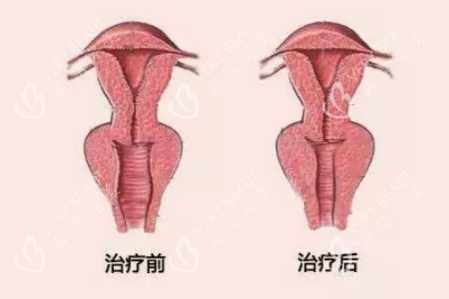 阴道紧缩卡通图