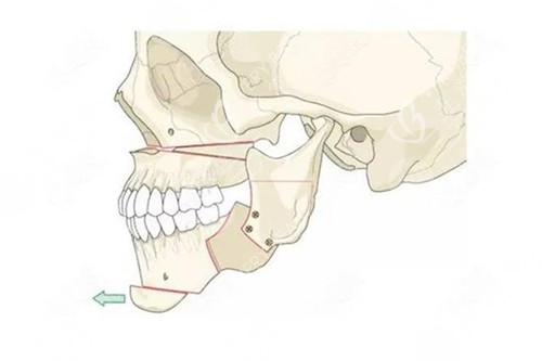 面部轮廓截骨手术示意图