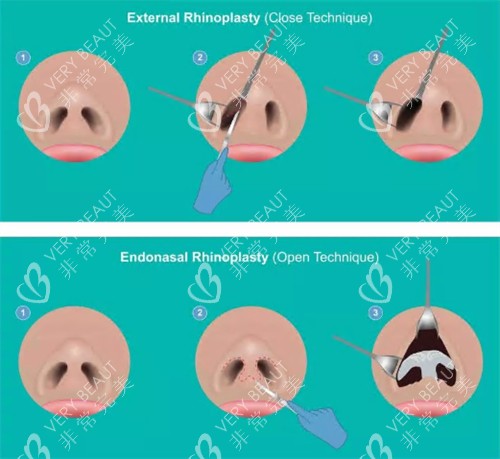 鼻整形过程图
