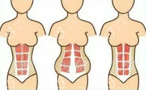 腹壁成形手术卡通示意图