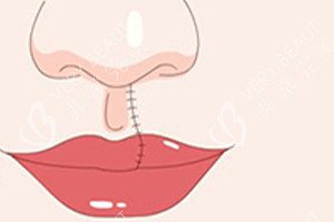 唇腭裂手术后动画示意图