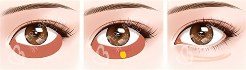 激光祛眼袋术过程