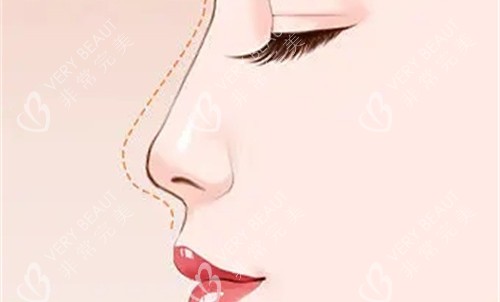 鼻部划线展示图