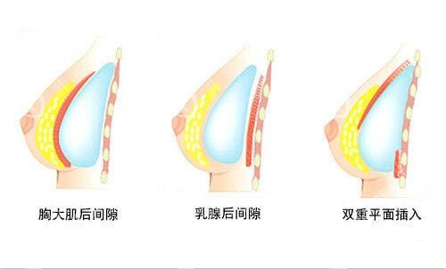 隆胸假体植入方式示意图