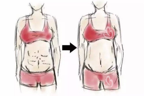 腹壁成型术卡通对比图