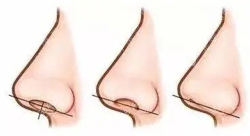 鼻部划线展示图