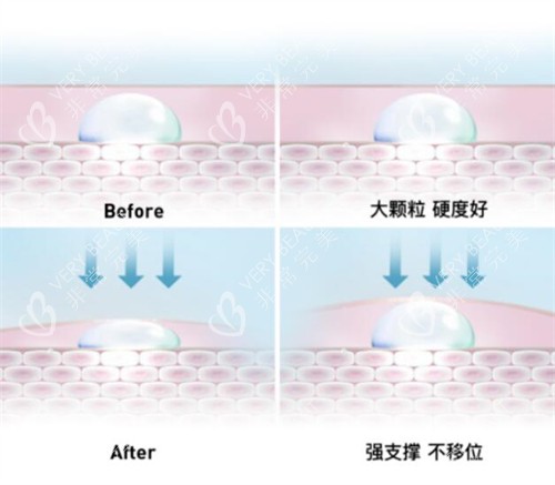 润致玻尿酸支撑情况展示