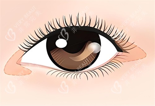 开内眼角和外眼角有什么区别，开眼角手术注意事项有哪些？