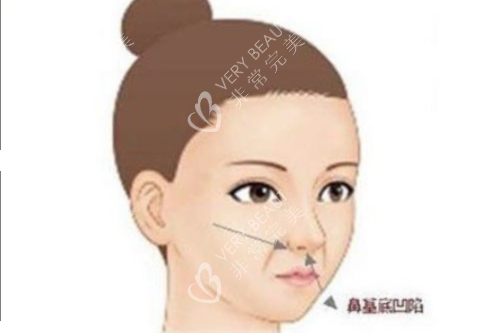 鼻基底凹陷