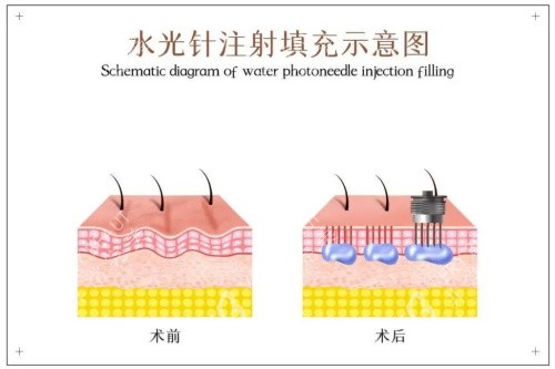 水光注射前后的区别