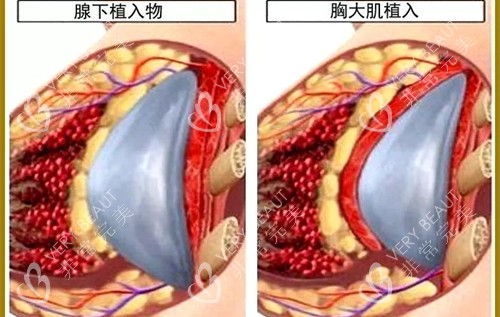 隆胸手术内部展示图