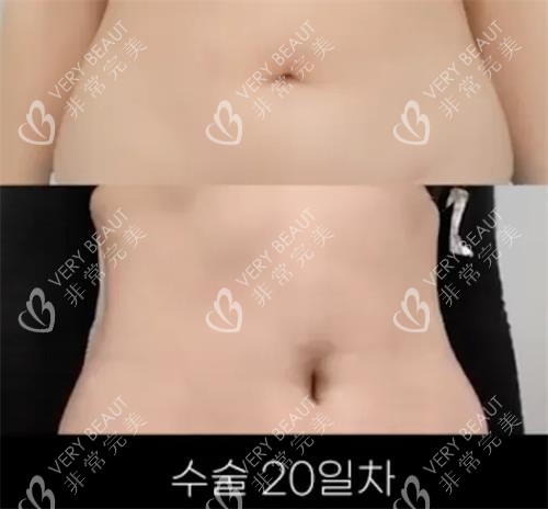 韩国肚脐整形示意图
