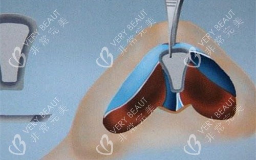 鼻头手术操作图