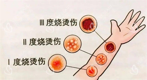 烧烫伤一度二度三度对比图片