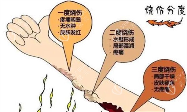 烧伤的不同程度展示