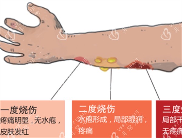 烧烫伤一度二度三度对比