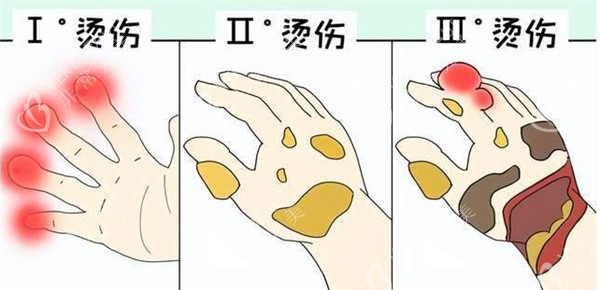 烧烫伤一度二度三度区别