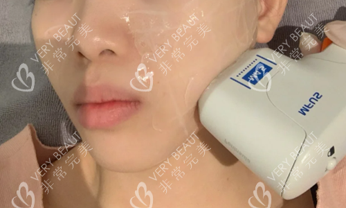 超声炮提拉示意图