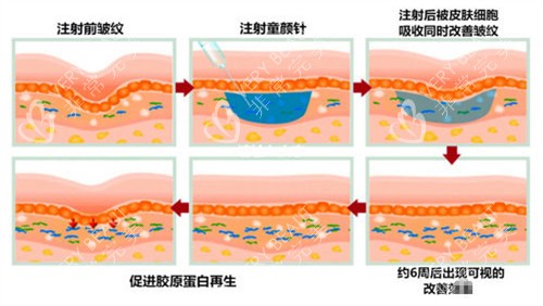 注射童颜针皮肤前后对比图