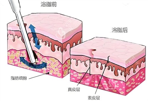 射频溶脂术皮肤层