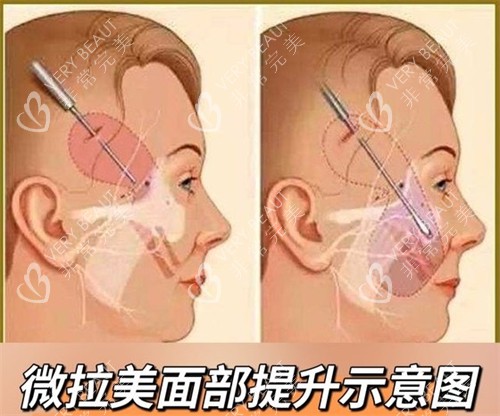 微拉美面部提升素材