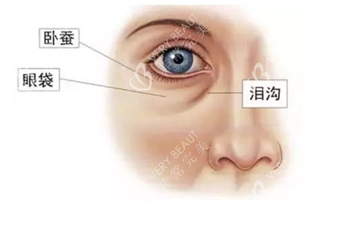 卧蚕和眼袋的区别