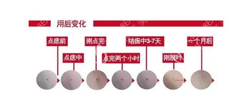 激光去痣后的成效