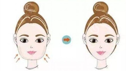 面部溶脂前后对比图
