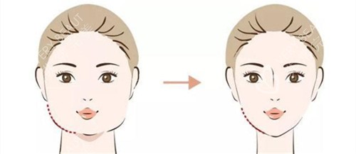 面部溶脂前后对比动画图