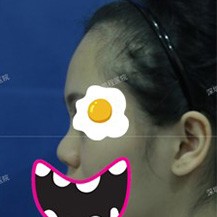 分享一例深圳鹏程医院鼻部整形真人对比日记！