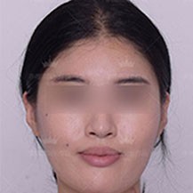分享我在上海伊莱美医院李湘原医生做的下颌角案例效果图!—上海伊莱美医疗美容医院