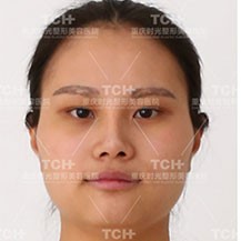 重庆时光整形下颌角改脸型手术日记对比分享!