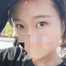 西安艺星整形医院吴刚做美杜莎综合美眼的日记前后对比!—西安艺星医疗美容医院整形日记