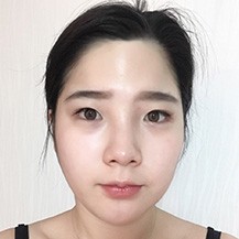 韩国迪美theM整形眼鼻+面部轮廓+面吸+线提升案例分享！