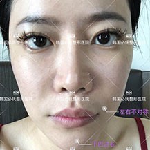 韩国必妩整形医院郑珍旭做面部轮廓双鄂手术的效果分享!