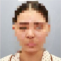 深圳希思整形医院做隆鼻手术的前后对比图展示!