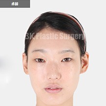 韩国BK整形美容医院双眼皮整形日记照片分享！