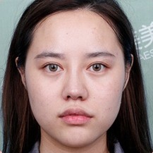 南京华美医疗美容医院鼻部综合整形真人日记对比！