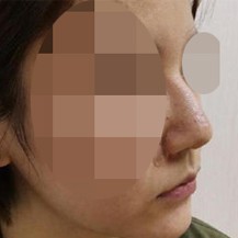 分享一组兰州韩美整形医院隆鼻手术真人案例!_兰州韩美医疗美容医院整形案例