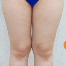 韩国Dr.creamy整形医院大腿及小腿吸脂真人案例分享