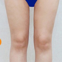 韩国Dr.creamy整形医院大腿及小腿吸脂真人案例分享—韩国Dr.creamy整形医院整形案例