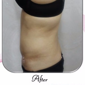 韩国Qline女性医院做的侧面腰腹部吸脂案例。—韩国Qline整形外科医院整形案例