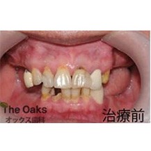 韩国橡树牙科医院种植牙案例—韩国橡树牙科医院整形案例