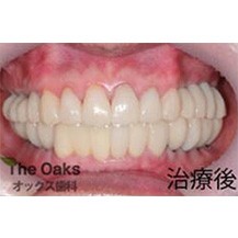 韩国橡树牙科医院种植牙案例—韩国橡树牙科医院整形案例