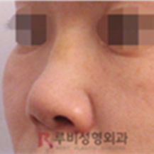 韩国RUBY如妃整形外科医院隆鼻修复手术—韩国RUBY如妃整形外科医院整形案例