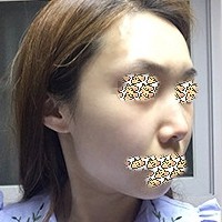 韩国然美之整形医院鼻综合案例手术前后对比，变化大！—韩国然美之整形外科整形案例